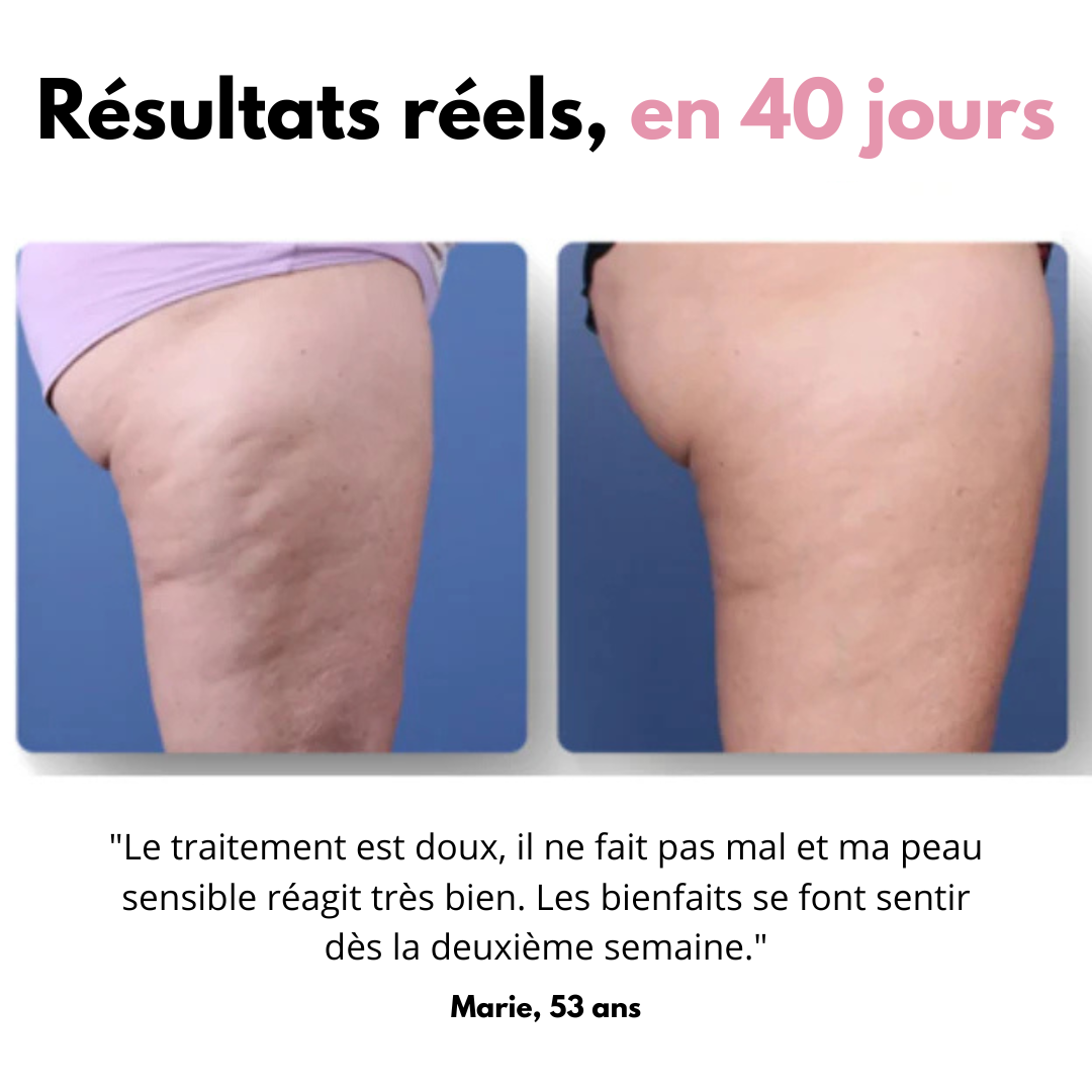 Masseur anti-cellulite Shapea